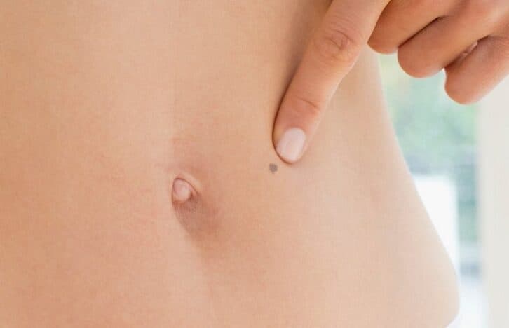 Стала відома причина швидкого розвитку раку шкіри на першій стадії